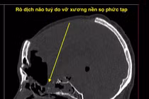 Nội soi nền sọ não vá rò dịch não tủy qua đường mũi