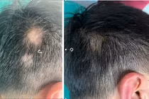 Tóc rụng từng mảng, bác sĩ mách cách chữa hiệu quả