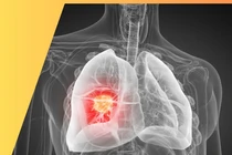 Đừng bỏ qua các thông tin cảnh báo ung thư phổi, điều trị đích