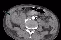 Đau thắt lưng, sốt, người bệnh nguy kịch vì viêm bể thận