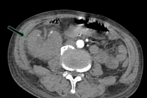 Đau thắt lưng, sốt, người bệnh nguy kịch vì viêm bể thận