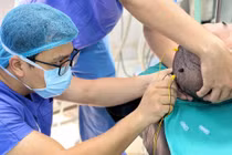 Đặt điện cực định vị cắt khối u thần kinh đệm kích thước lớn 8cm trong não