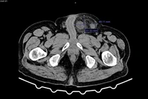 Chủ quan với khối thoát vị bẹn người đàn ông bị hoại tử đại tràng