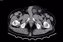 Chủ quan với khối thoát vị bẹn người đàn ông bị hoại tử đại tràng
