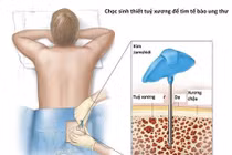 Dấu hiệu nhận biết sớm bệnh xơ tủy