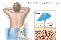 Dấu hiệu nhận biết sớm bệnh xơ tủy