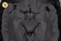 Nhìn mờ chỉ định chữa mộng mắt không khỏi, hóa ra huyết khối tĩnh mạch não