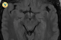 Nhìn mờ chỉ định chữa mộng mắt không khỏi, hóa ra huyết khối tĩnh mạch não