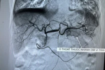 Cứu sống bệnh nhân K thực quản giai đoạn cuối, chảy máu dạ dày ồ ạt