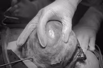 Đau bụng 3 ngày, u buồng trứng “khổng lồ” xoắn, hoại tử