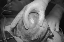 Đau bụng 3 ngày, u buồng trứng “khổng lồ” xoắn, hoại tử