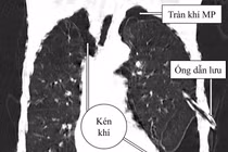 Tràn khí màng phổi phức tạp do kén khí vỡ