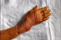 Cảnh báo bó thuốc nam chữa gãy xương, lợi bất cập hại