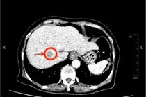 Đau nhẹ vùng thượng vị, đi khám phát hiện u gan phức tạp