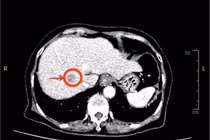 Đau nhẹ vùng thượng vị, đi khám phát hiện u gan phức tạp