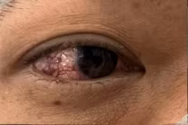 Lồi mắt, đỏ mắt không ngờ bệnh lý hiếm gặp thông động mạch cảnh xoang hang