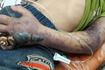 Bị rắn độc cắn, đừng để mất mạng vì tin thầy lang, thuốc lá