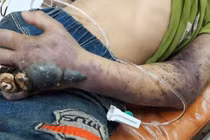 Bị rắn độc cắn, đừng để mất mạng vì tin thầy lang, thuốc lá