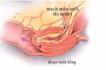 Trẻ 7 tháng tuổi quấy khóc, nôn trớ không ngờ nguy kịch vì lồng ruột