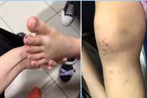 Tự dùng thuốc gút người bệnh dị ứng toàn thân nghiêm trọng