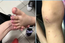 Tự dùng thuốc gút người bệnh dị ứng toàn thân nghiêm trọng