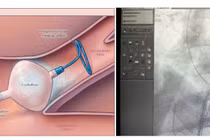 Nhiệt lạnh điều trị rung nhĩ tránh suy tim, đột quỵ