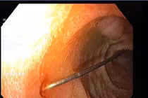 Gắp thành công kim dài 4cm trong tá tràng bé 11 tháng tuổi ngay trong đêm