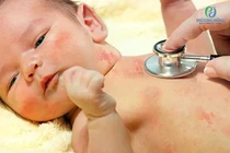 Bé sơ sinh 15 ngày tuổi bị thủy đậu biến chứng ác tính