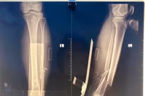 Không thể cử động chân, người đàn ông 71 tuổi gãy kín 2 xương 