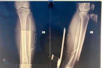 Không thể cử động chân, người đàn ông 71 tuổi gãy kín 2 xương 