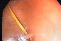 Ngậm tăm ngủ quên gây thủng dạ dày tạo ổ áp xe