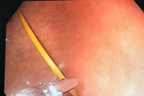 Ngậm tăm ngủ quên gây thủng dạ dày tạo ổ áp xe