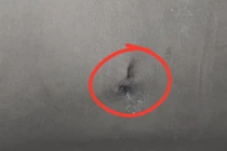 Bé 9 tuổi bị sỏi thận kích thước lớn gây thận ứ nước