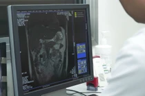 Từng bị đột quỵ nhưng tái phát vẫn nhập viện muộn, có bị coi nhẹ?