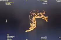 Đau đầu do tăng huyết áp, người phụ nữ 65 tuổi vỡ mạch máu não