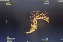 Đau đầu do tăng huyết áp, người phụ nữ 65 tuổi vỡ mạch máu não