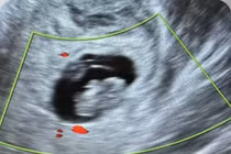 Siêu âm không phát hiện túi thai, thai phụ vỡ khối chửa nguy kịch
