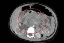 Bé 3 tuổi đã ung thư tinh hoàn, cha mẹ cần chú ý kiểm tra khi trẻ mới sinh