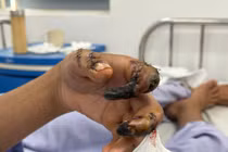 Thanh niên 18 tuổi bị hoại tử các đốt ngón tay do tai nạn lao động