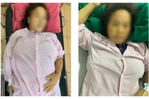 Sản phụ người Mông 2 lần nguy kịch vì tự ý dùng thuốc phá thai tại nhà