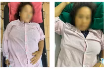 Sản phụ người Mông 2 lần nguy kịch vì tự ý dùng thuốc phá thai tại nhà