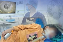 Kịp thời xử trí, lấy dị vật đường tiêu hóa an toàn cho bé gái 7 tuổi