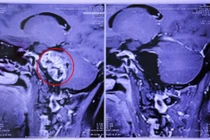 Phẫu thuật thành công u góc cầu tiểu não phức tạp cho 2 bệnh nhân