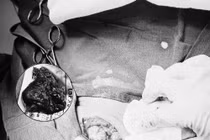 Trẻ 17 tuổi mới phát hiện rò khe mang do dị tật bẩm sinh