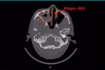 Đau đầu, tắc mũi... kéo dài, Việt kiều Mỹ về Việt Nam chữa viêm xoang nấm