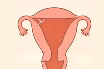 3 lần tháo vòng không thành công vì vòng cắm vào tử cung