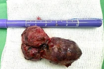 Phẫu thuật u tuyến nước bọt mang tai cho nam bệnh nhân 53 tuổi