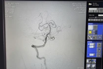 Đang nằm viện trị nhồi máu cơ tim, bệnh nhân đột quỵ do tắc thân nền