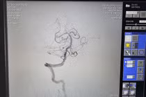 Đang nằm viện trị nhồi máu cơ tim, bệnh nhân đột quỵ do tắc thân nền