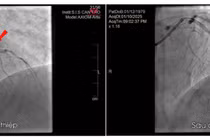 Cứu nam bệnh nhân bị nhồi máu cơ tim cấp sau 2 năm đau ngực âm ỉ